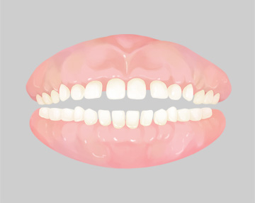 벌어진 치아 그림