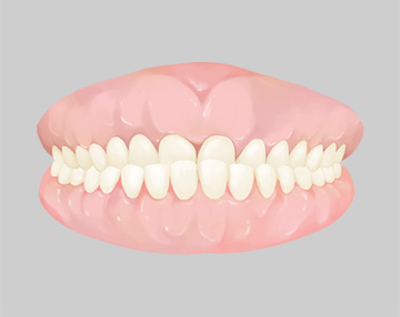 부정교합 그림